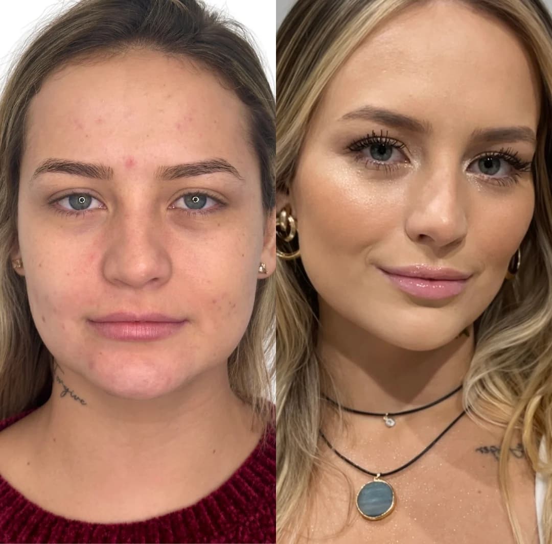 Resultado de harmonização facial com planejamento Full Face