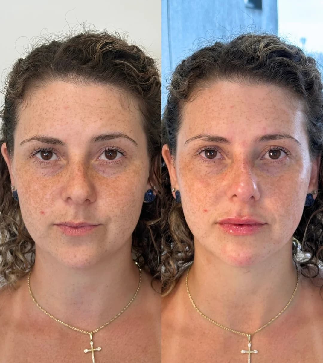 Registro autorizado de harmonização facial em consultório