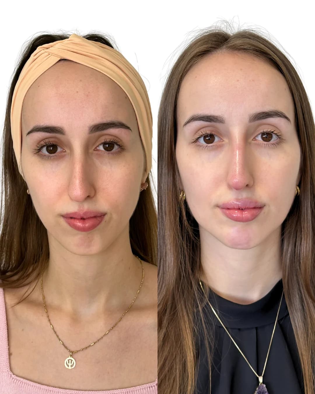 Resultado autorizado de planejamento facial Full Face