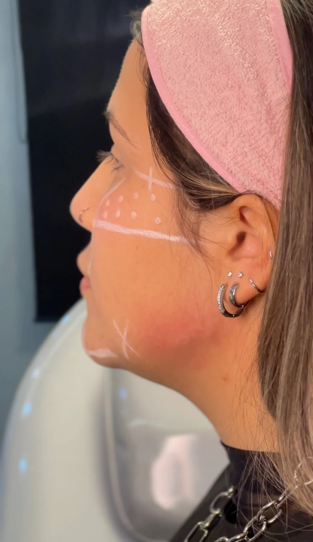 Análise de perfil para planejamento facial Full Face