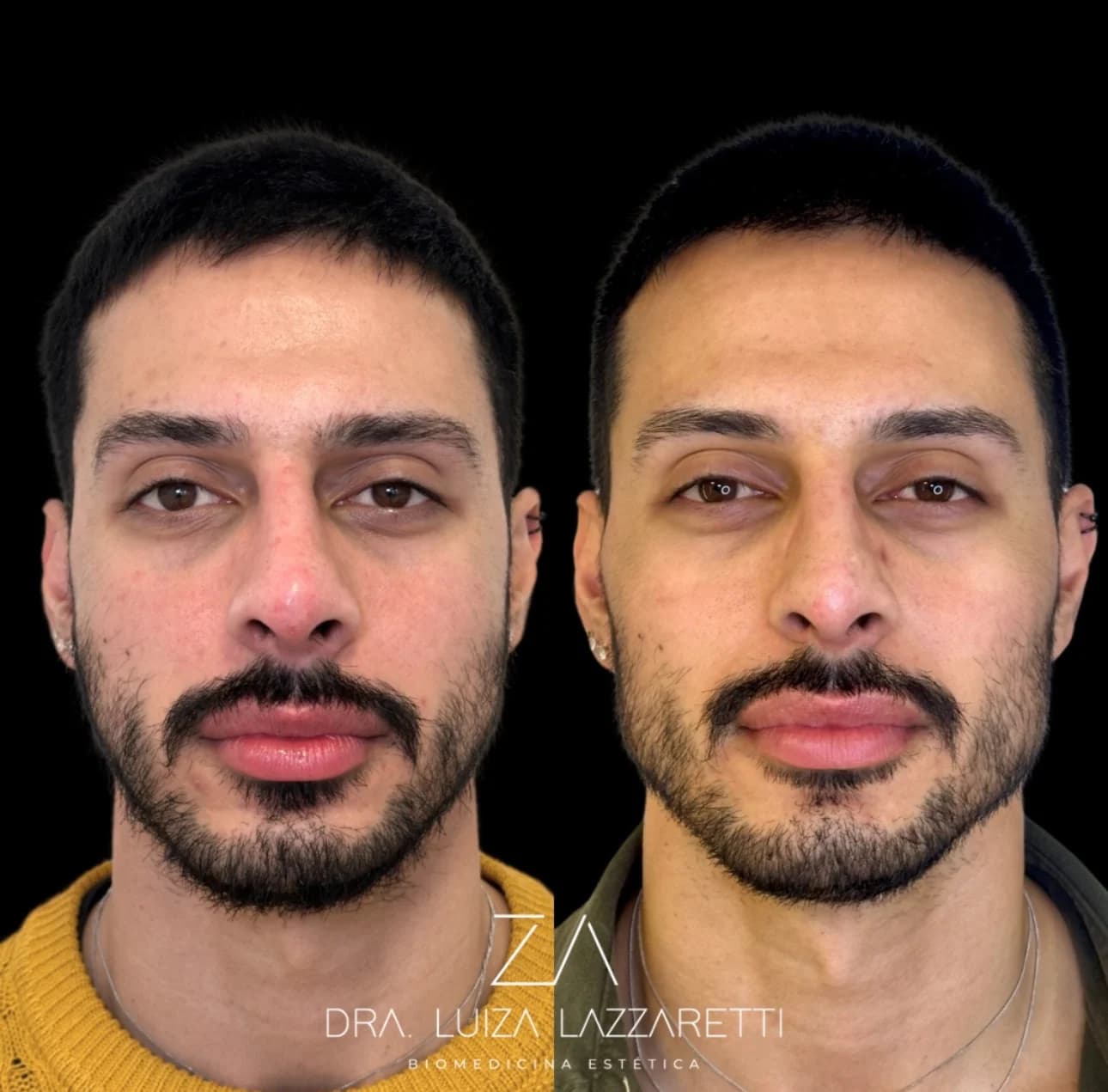 Planejamento de harmonização facial masculina com resultado discreto