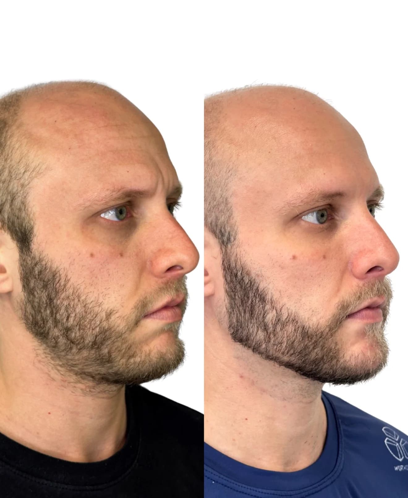 Imagem principal de harmonização facial masculina com naturalidade