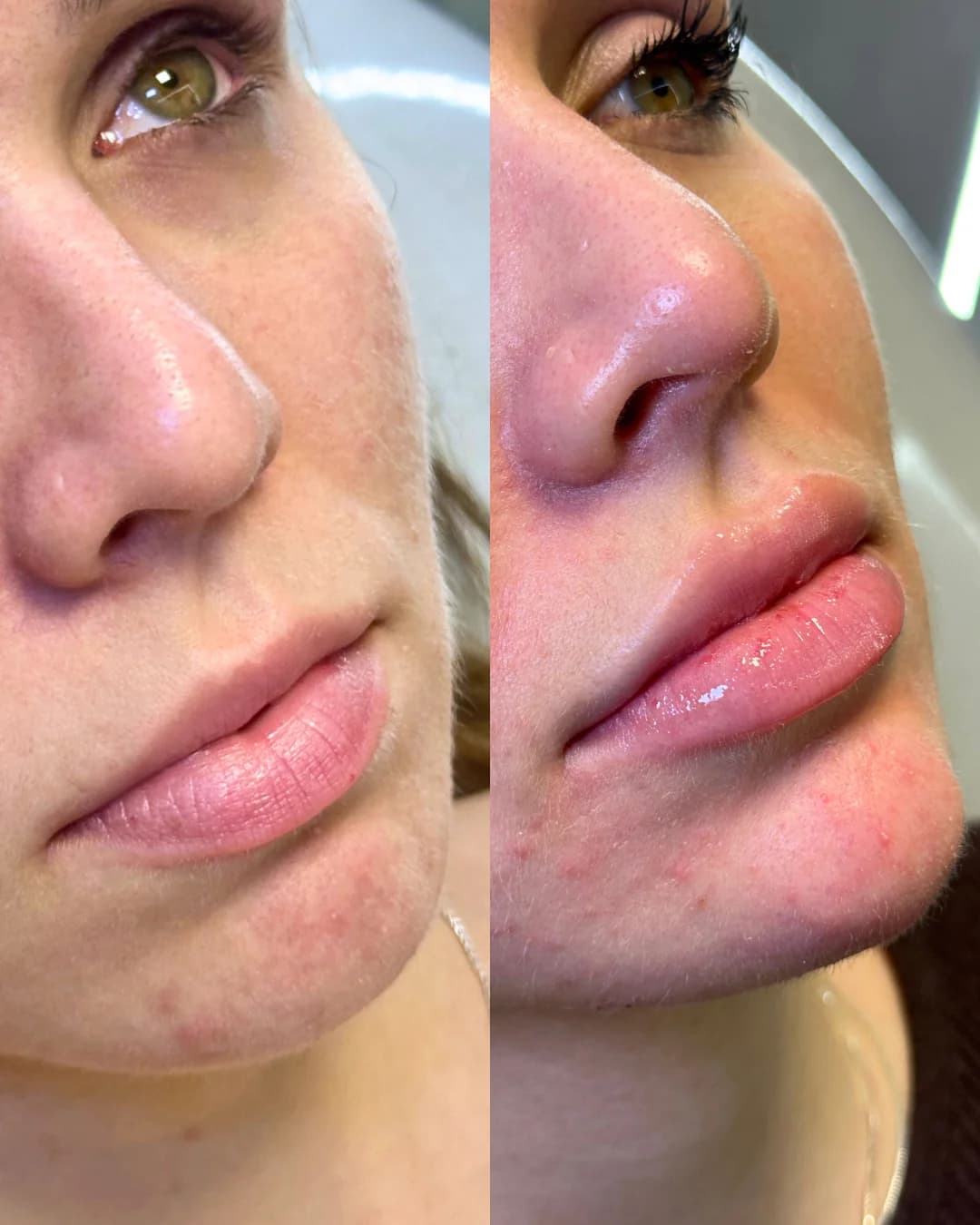 Planejamento de preenchimento labial com proporção e naturalidade
