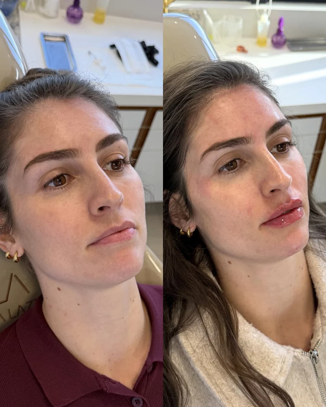 Registro autorizado de preenchimento labial natural