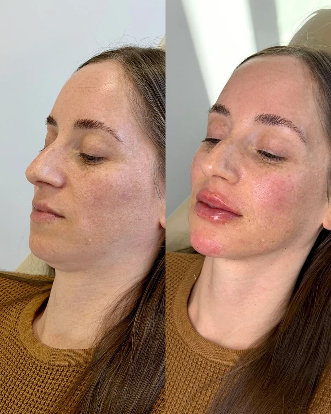 Paciente em planejamento de preenchimento labial