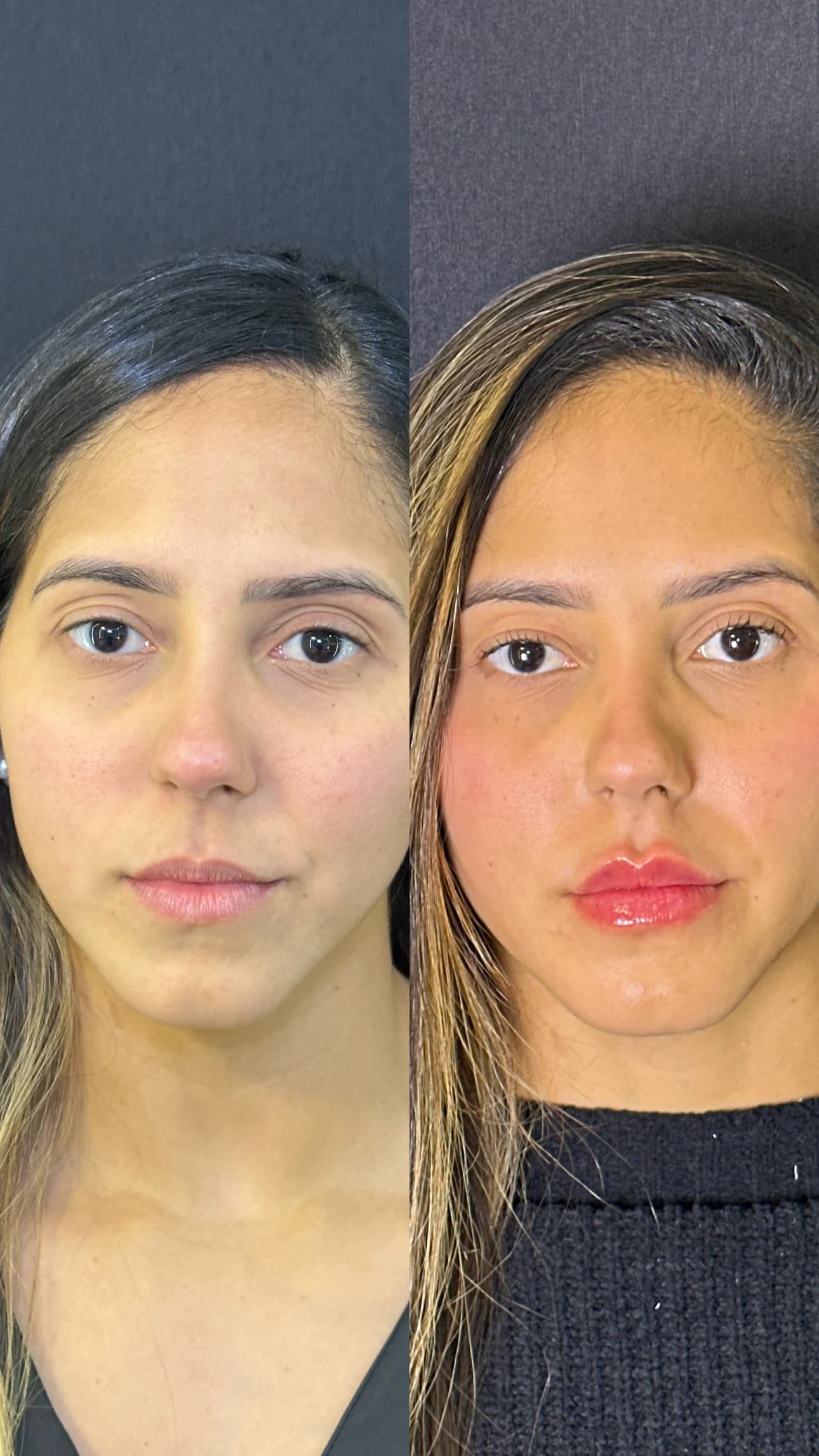 Atendimento relacionado ao preenchimento labial