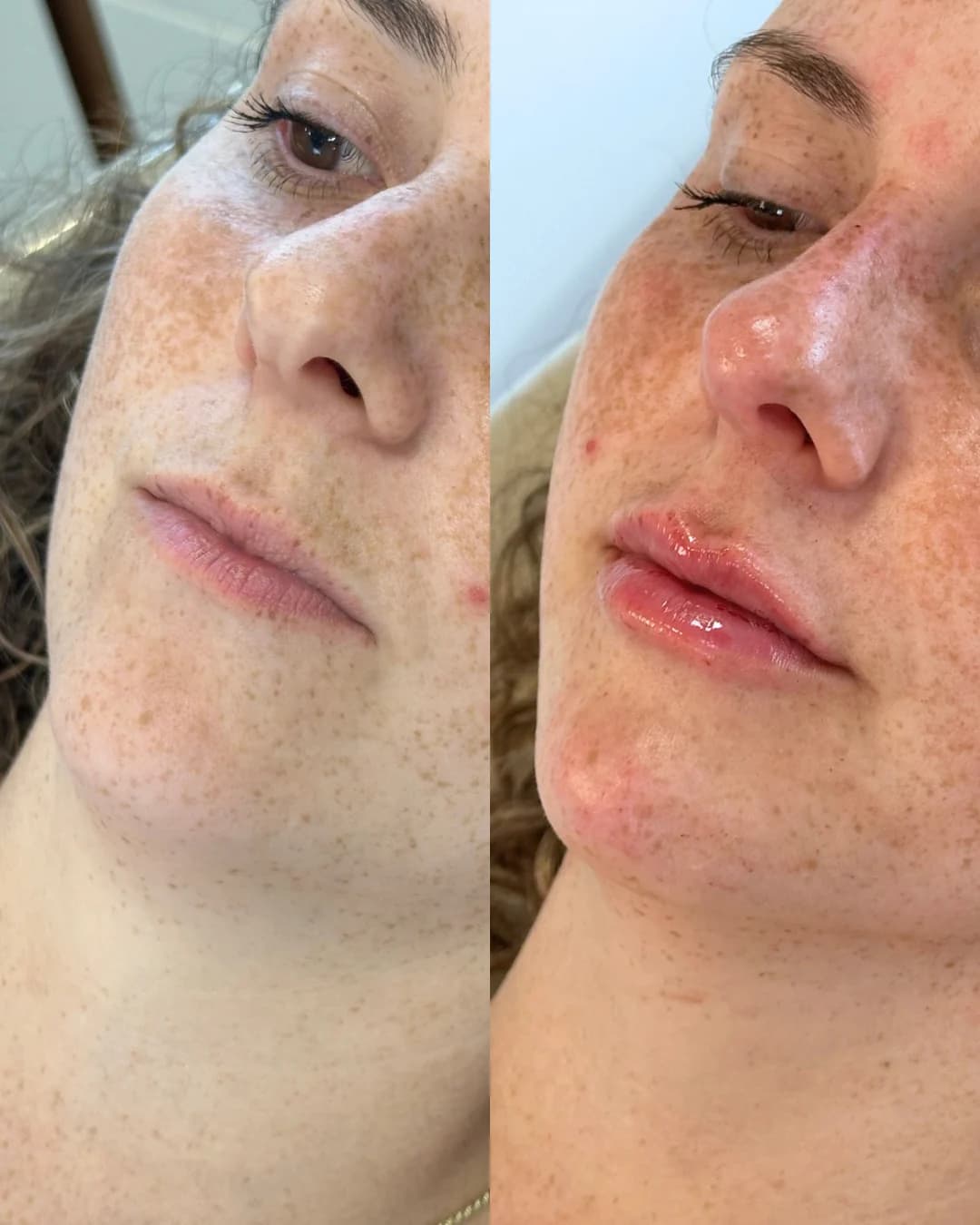 Imagem principal de preenchimento labial com proporção e harmonia