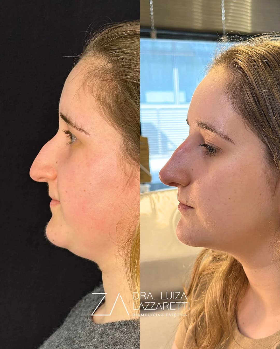 Análise facial relacionada à rinomodelação