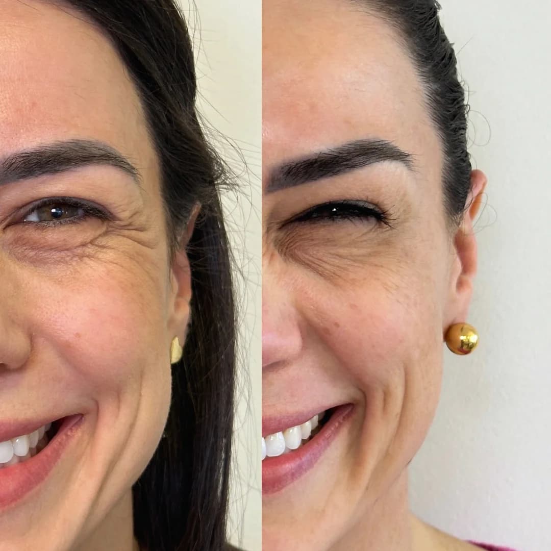 Expressão facial em planejamento de toxina botulínica