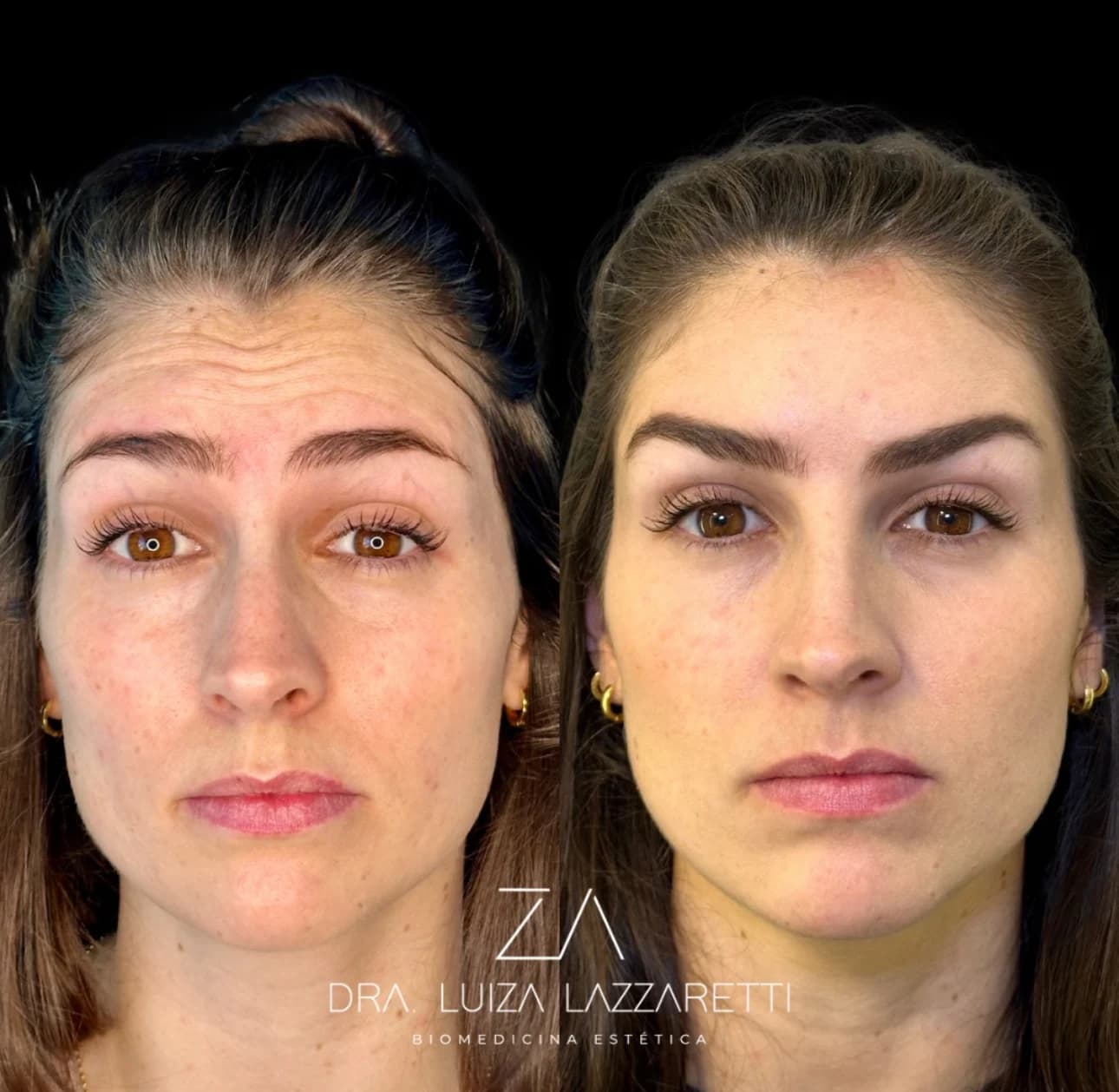 Atendimento com toxina botulínica planejado para expressão natural