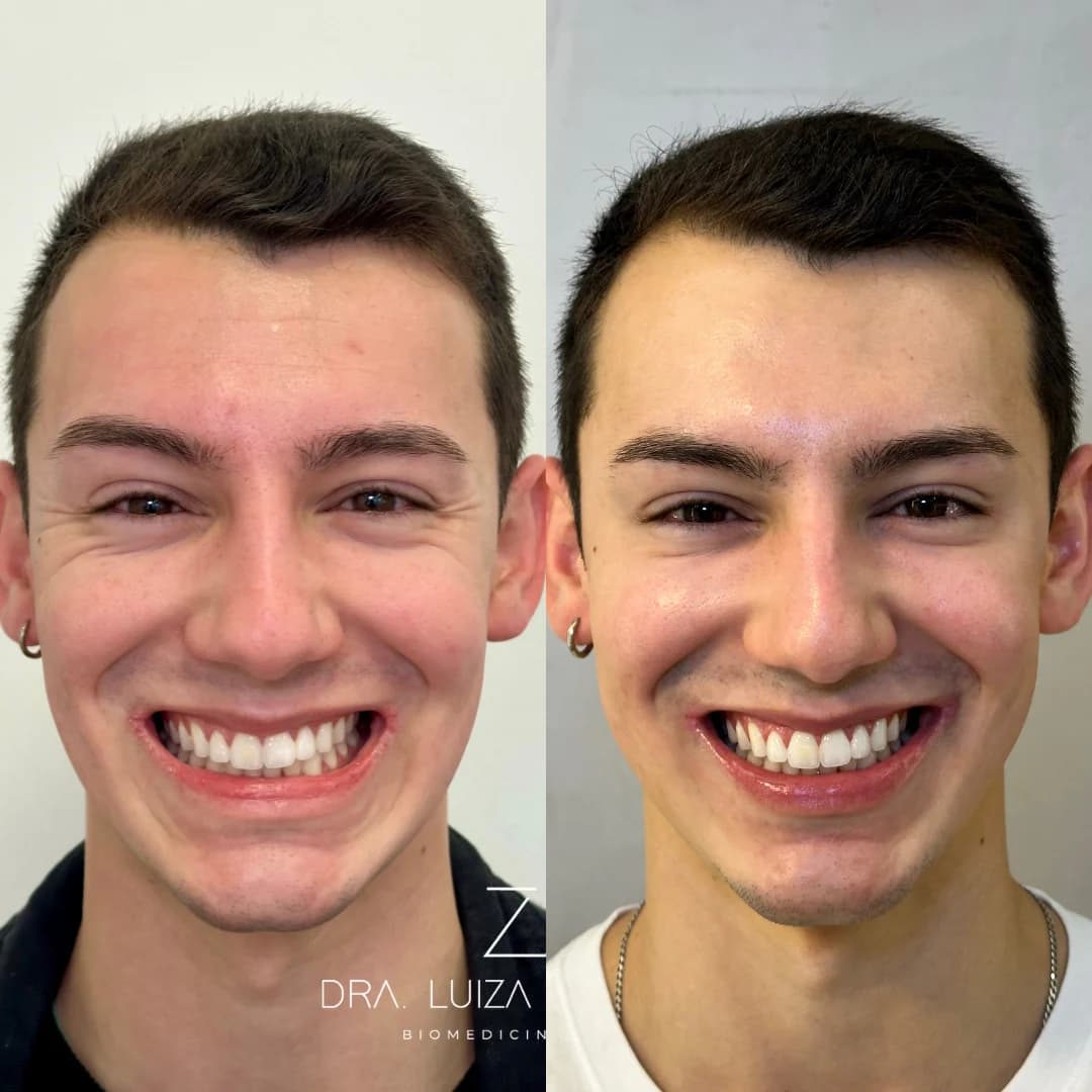 Registro autorizado de toxina botulínica com resultado natural