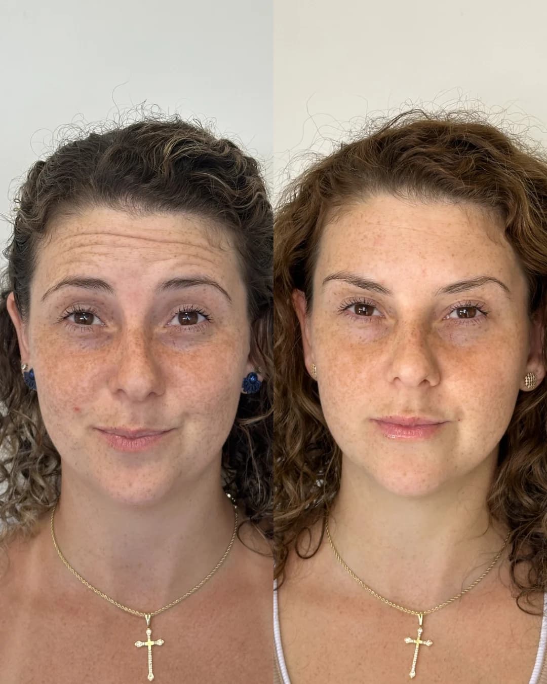 Paciente em atendimento de toxina botulínica com a Dra. Luiza
