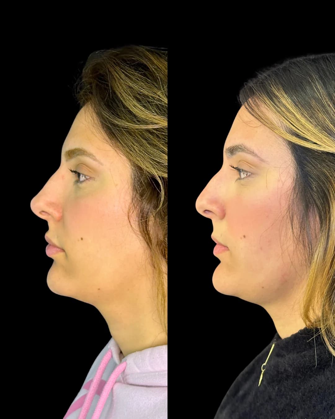 Comparação de perfil facial em planejamento de perfiloplastia