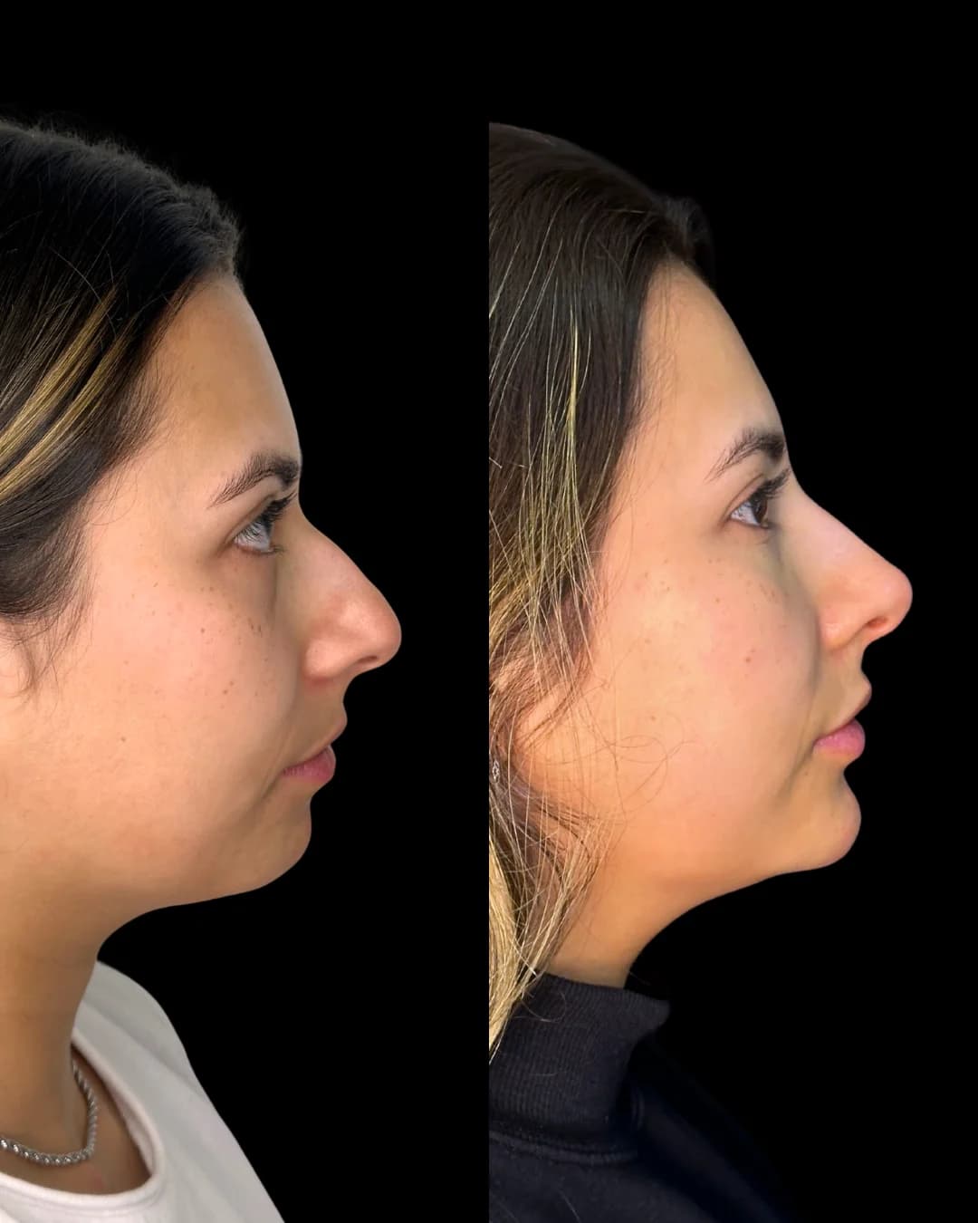 Análise de perfil facial para perfiloplastia não cirúrgica