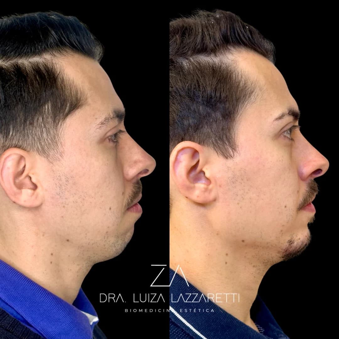 Registro autorizado de perfiloplastia não cirúrgica