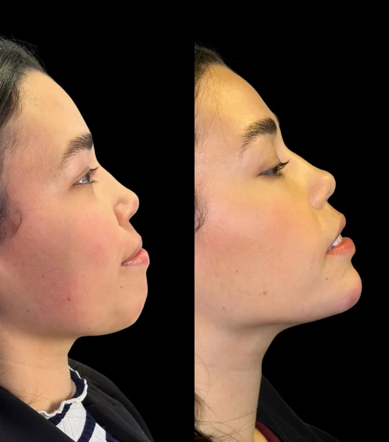 Análise de perfil facial para perfiloplastia