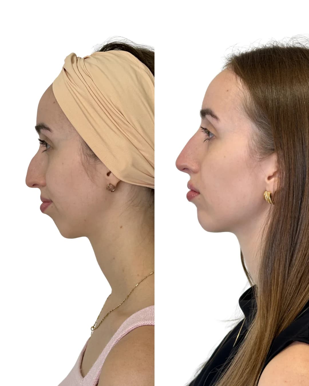 Registro autorizado de resultado em perfiloplastia