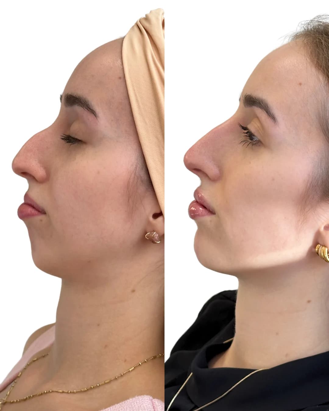 Análise facial para planejamento de mento