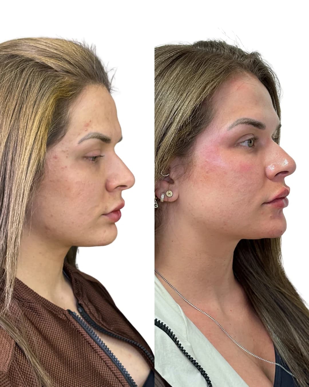 Paciente em atendimento para preenchimentos faciais