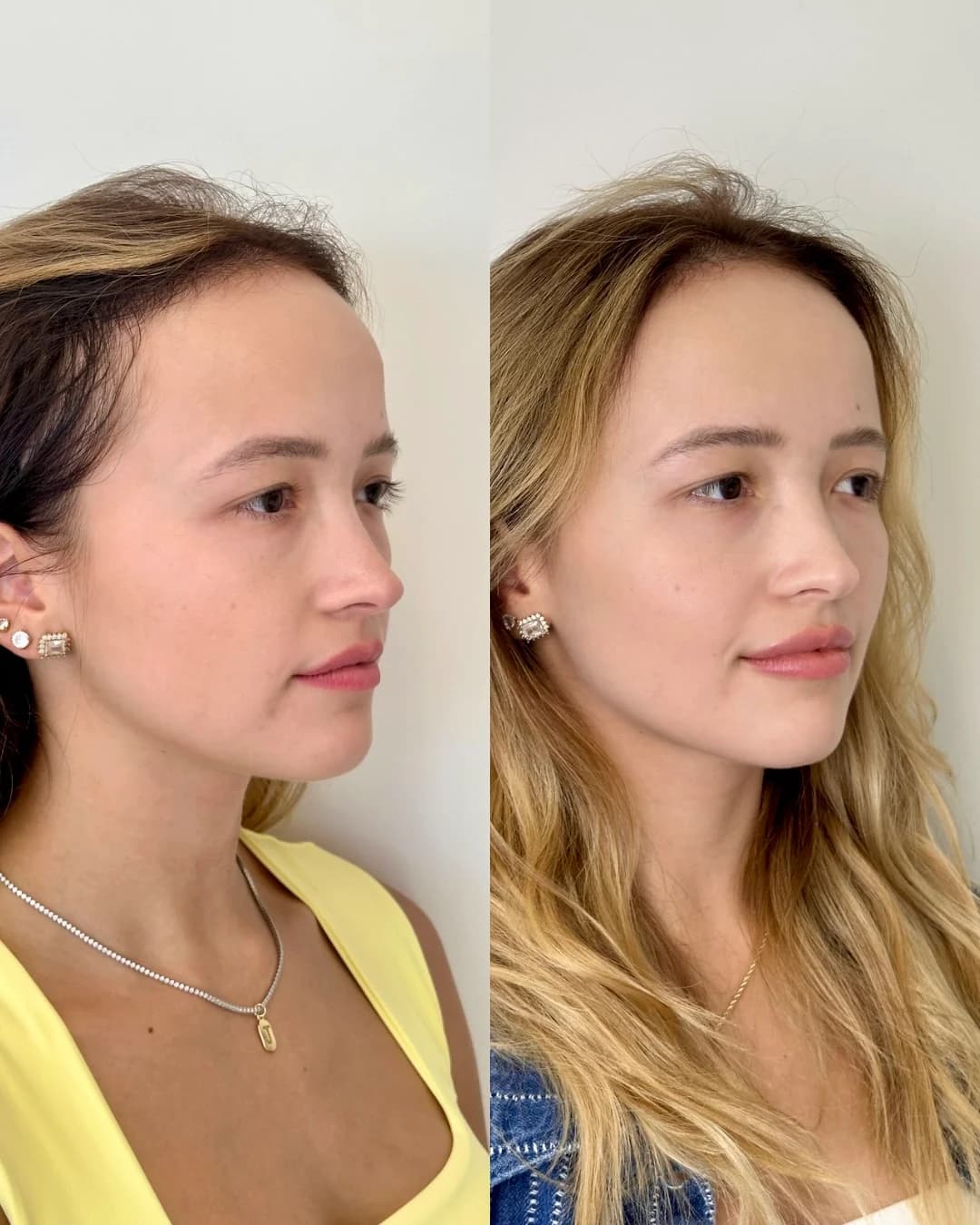 Resultado autorizado de preenchimentos faciais naturais