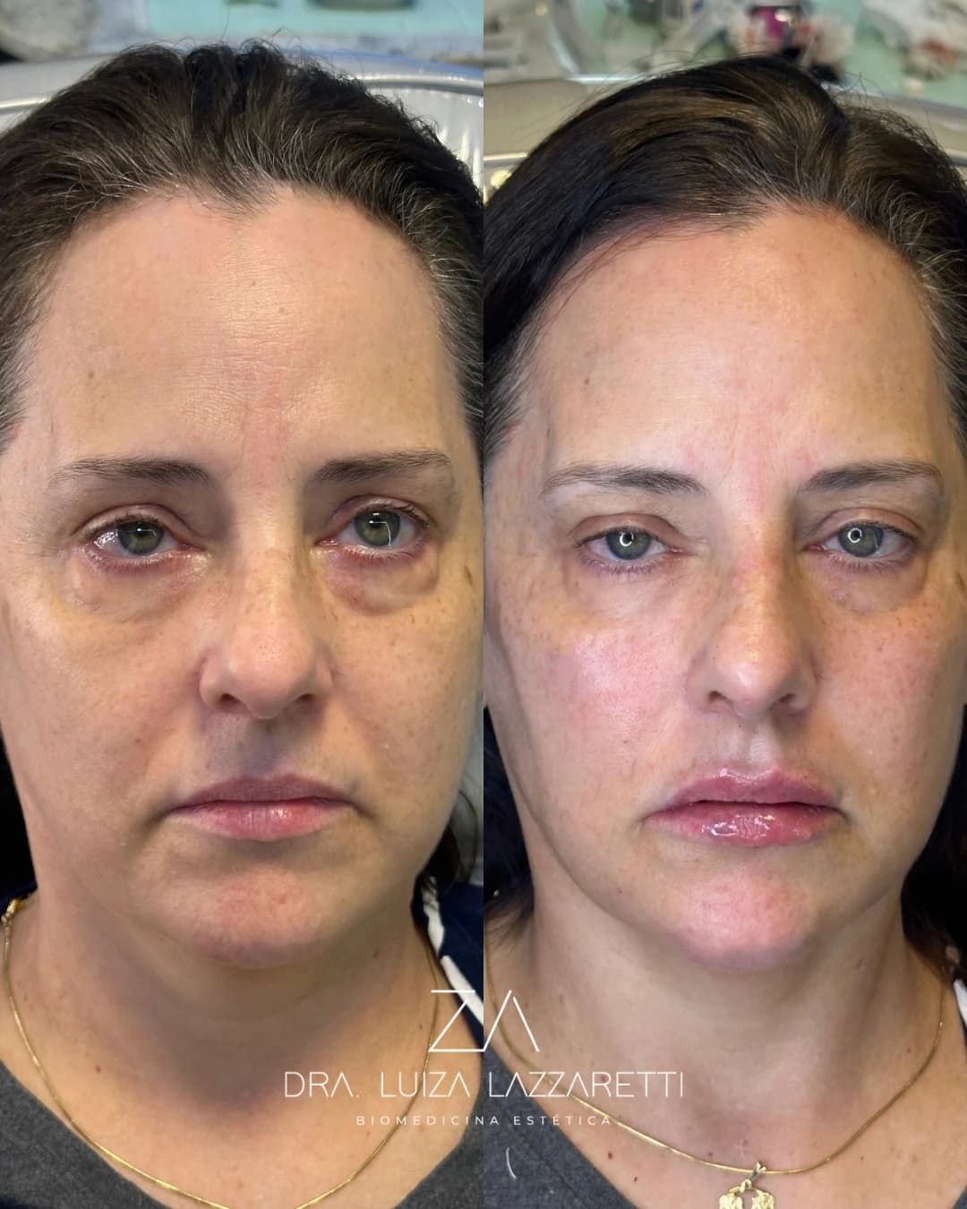 Resultado natural em planejamento de rejuvenescimento facial