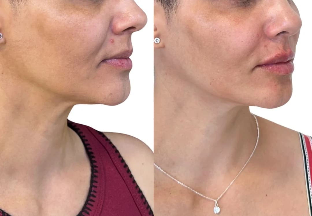 Registro autorizado de rejuvenescimento facial natural